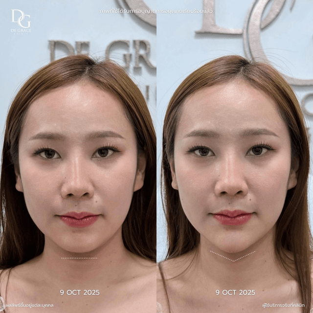 Face Contouring Treatment